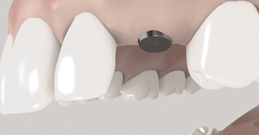 La pose d'un implant en 2 temps