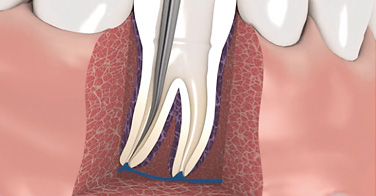 Traitement endodontique