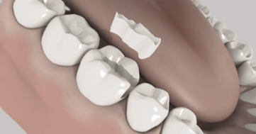 Le traitement non chirurgical de la parodontite